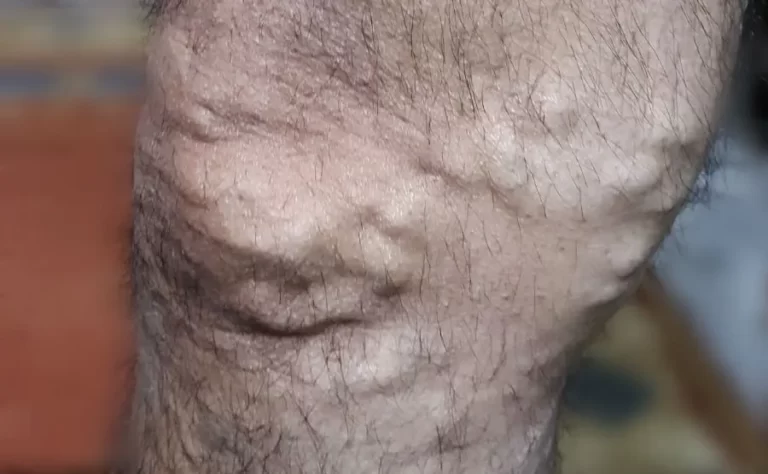 chronic venous insufficiency