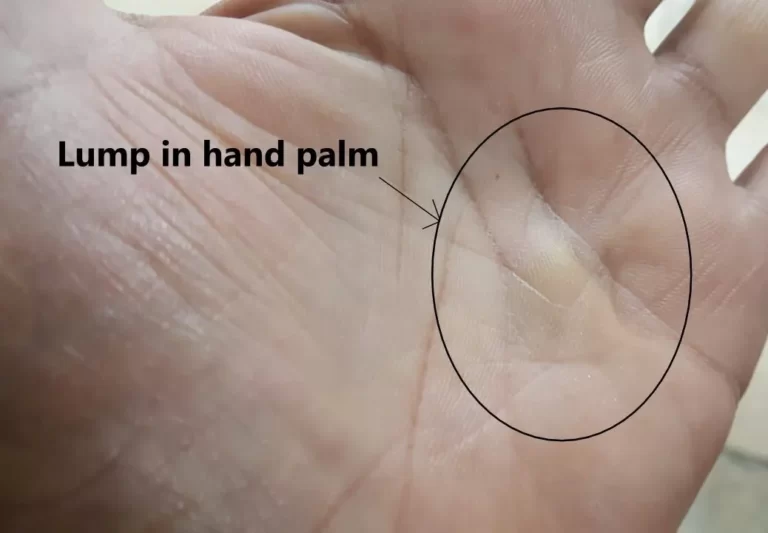 Dupuytren's contracture