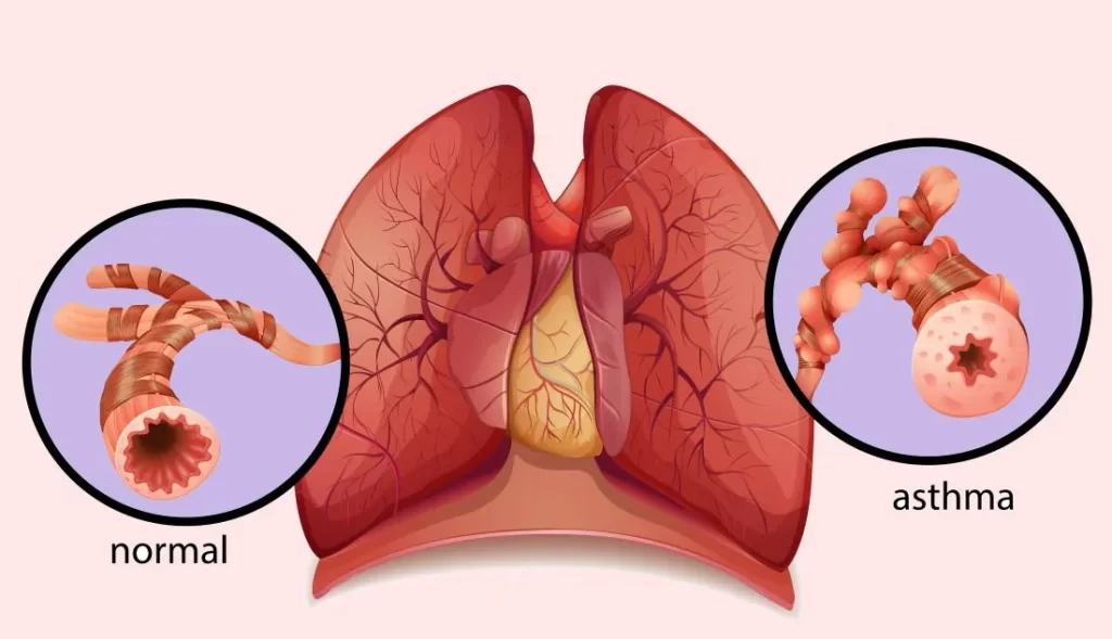 asthma