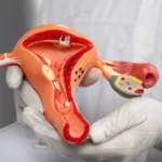 Polycystic ovary syndrome