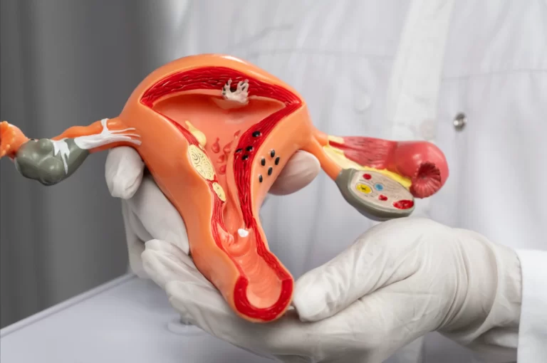 Polycystic ovary syndrome