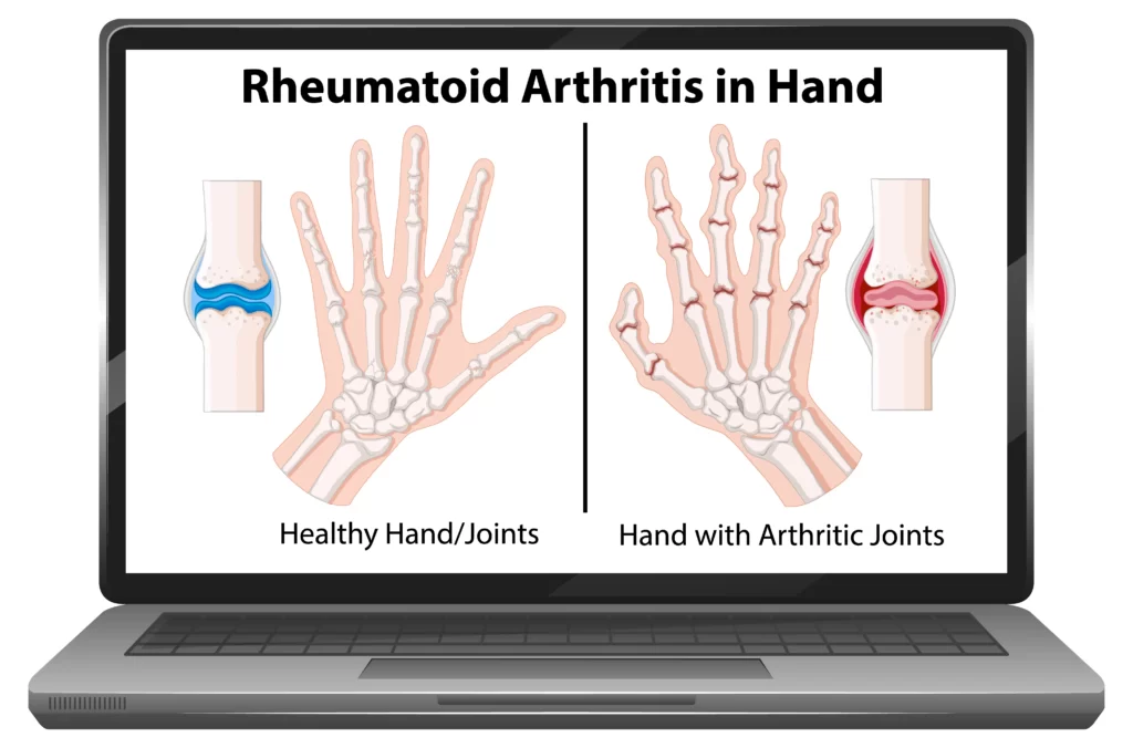 Rheumatoid arthritis