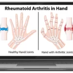 Rheumatoid arthritis