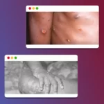 The first case of a monkeypox infection