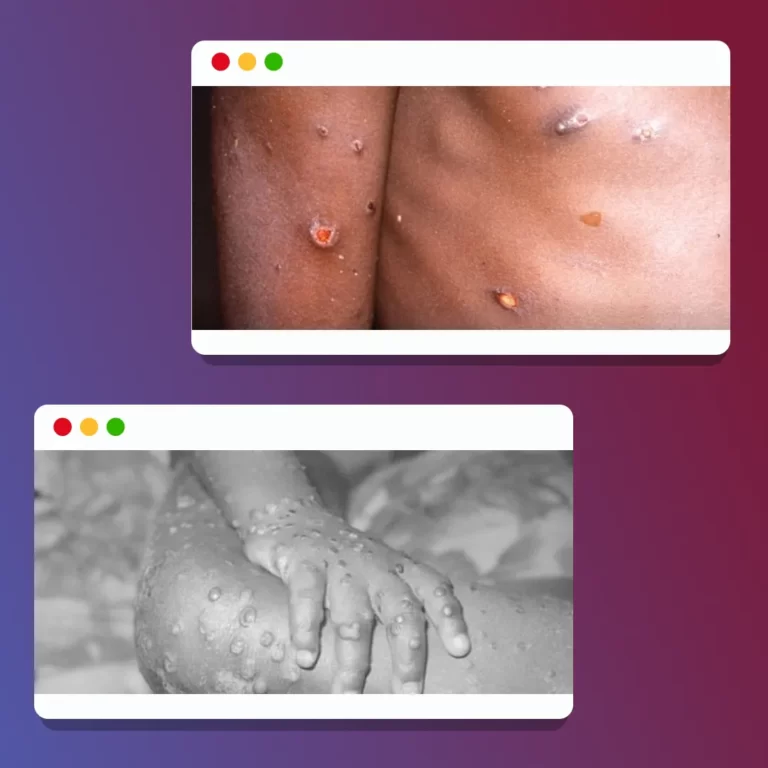 The first case of a monkeypox infection